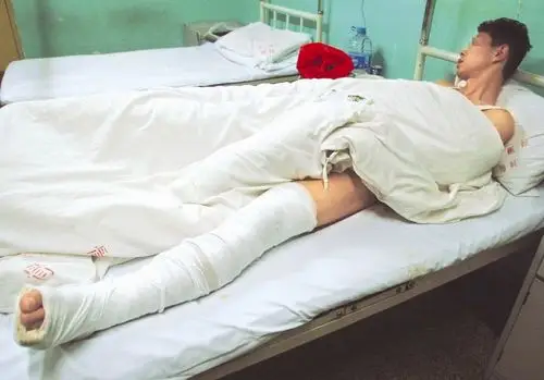 湖北小伙绊倒逃窜小偷,小腿被踢断