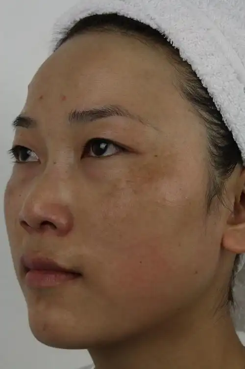 想彻底祛除黄褐斑,了解几个问题能就搞定脸上的斑