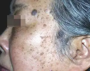 扁平疣的"前世今生"