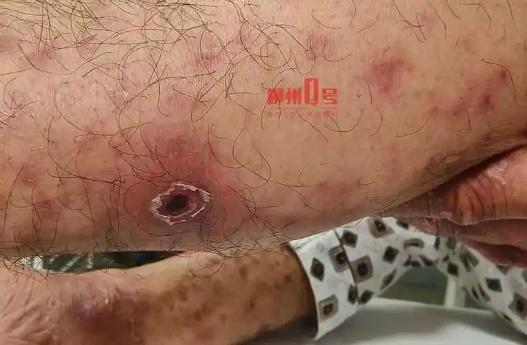 挨咬一口困软半个月!柳州一男子的遭遇跟狗狗有关