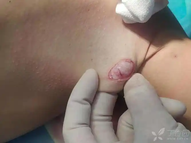 【其它】关于腋臭的范围及大汗腺位置的请教