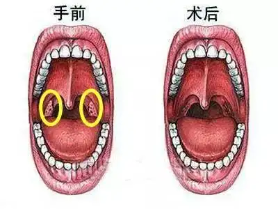 扁桃体具有免疫功能,它的淋巴细胞核抗体可以消灭和控制病菌,在口腔