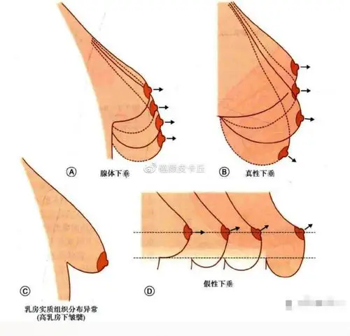 九种方案矫正乳房下垂你应该选哪一种