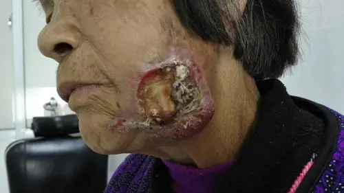 左侧面部鳞状细胞癌