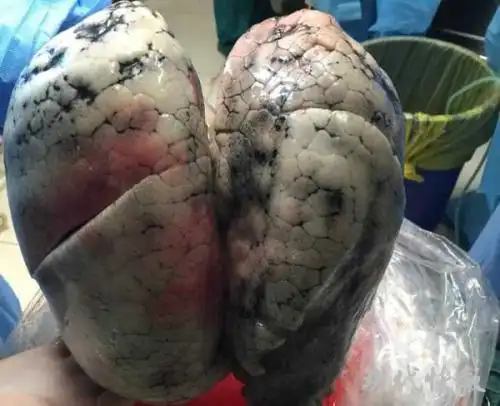 抽烟一年肺会黑吗