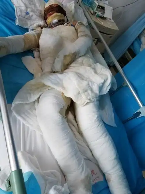 姐姐全身百分之九十面积烧伤