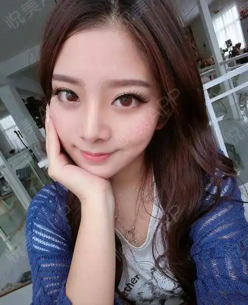 玻尿酸面部填充术后19天_填充塑形术后19天_玻尿酸术后19天_面部轮廓