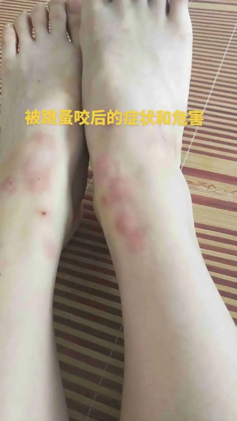 跳蚤咬后的危害!1,红疹  跳蚤身上存在大量的细菌和病毒,如 - 抖音