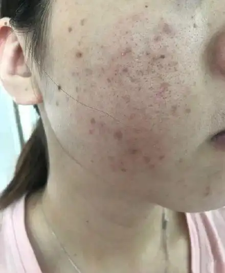 痘痘肌也能做的4个医美项目!效果堪比换脸!