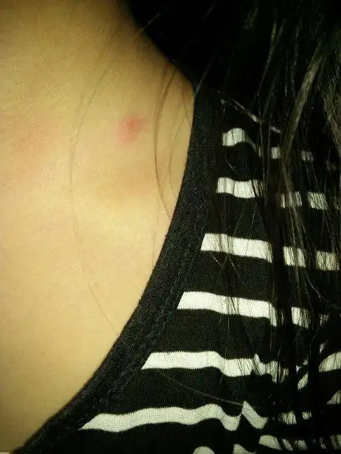 0 次来自:手机知道   分享到:  14 分钟前  提问者采纳 可能虱子咬的