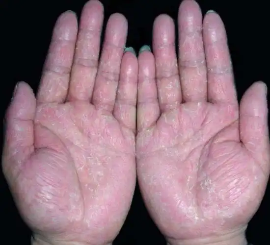 鹅掌风都有哪些症状小妙招巧去鹅掌风