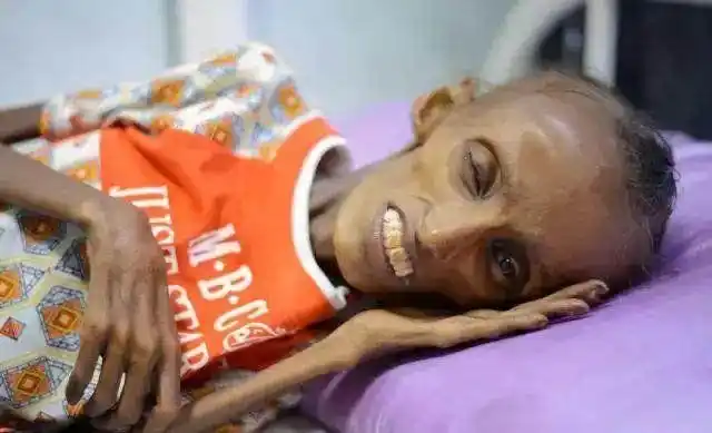 瘦如皮包骨头的十八岁女孩,只因为没有吃的