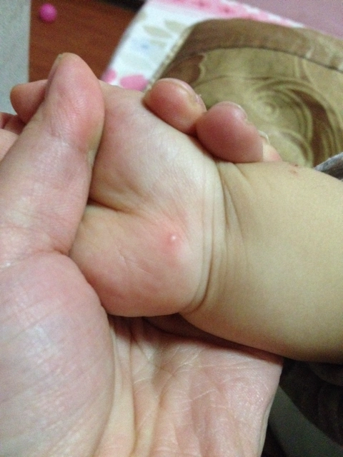 有没有宝宝的过丘疹性寻麻疹