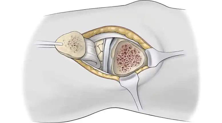 一文盘点:胫骨平台的六种入路