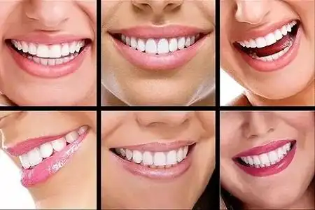 矫正牙齿整形资讯