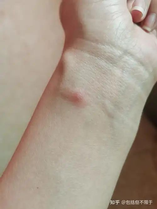 被红蚂蚁咬伤有什么症状?