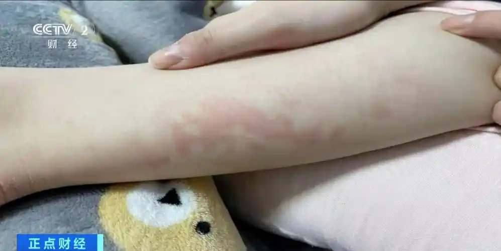 冬季警惕发生低温烫伤医生提醒不要通宵使用电热毯