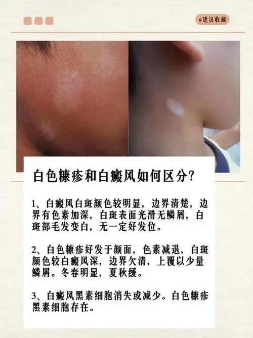 同样是白斑,白色糠疹和白癜风如何区分?详