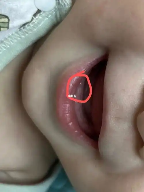 婴儿长牙  #宝宝出牙 #出牙期的宝宝症状今天小牙已经冒尖尖了出咽北