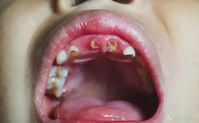 10个孩子7个烂牙被疯传的乳牙无用论坑害了多少孩子