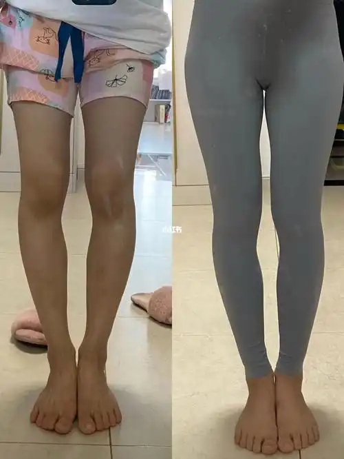 xo型腿矫正案例(文字教程97,无偿看腿