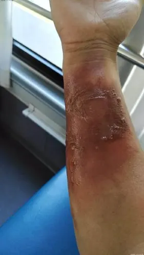 福特嘉年华气囊弹出后将手炸伤,伤情触目惊心,据说是高田气囊