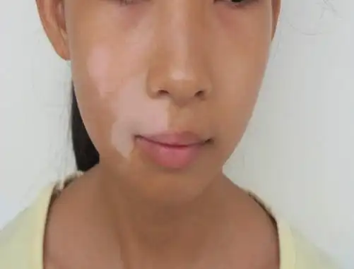 白斑与白癜风的区别
