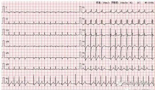 心电读图系列笔记