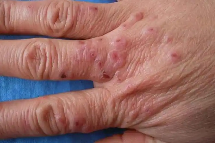 寒冷性湿疹的症状图片