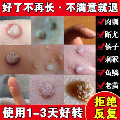 【药房直发】药鱼鳞痣祛肉粒疙瘩治瘊子休子药刺猴药