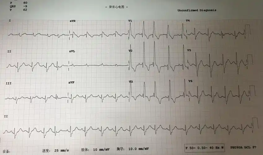 右室肥大 右束支阻滞? - 心电图脑电图专业讨论版 - 爱爱医医学论坛