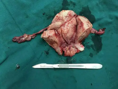 腹腔镜下子宫全切术 双侧输卵管切除术.