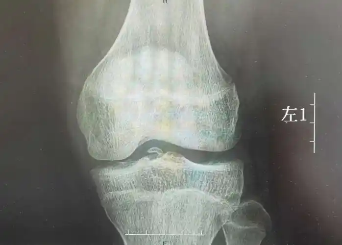 沧州市人民医院骨三科关节镜微创治疗胫骨髁间棘撕脱骨折伴外侧半月板