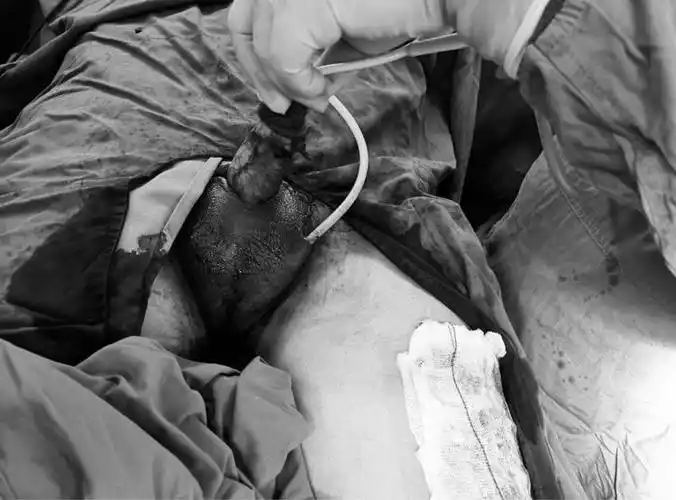 手术工作日志23:怎样预防阴囊湿疹样癌/阴囊paget病?