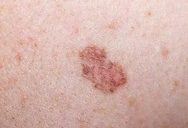 赵忠祥老师去世病因:鳞状细胞癌是个啥玩意儿?早期症状是什么?