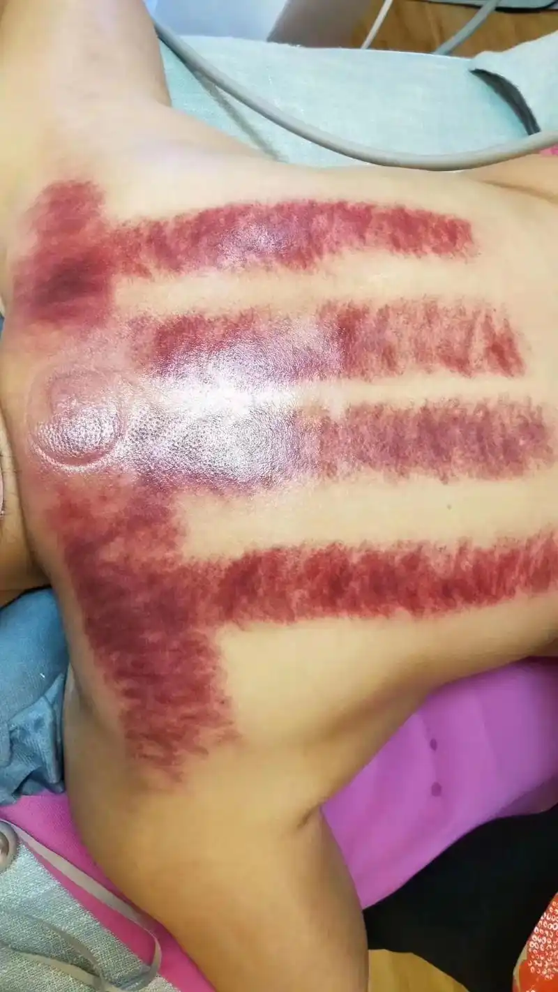 做背知识普及: 做身体出痧出的颜色分为6种: 1.黑痧:寒; - 抖音