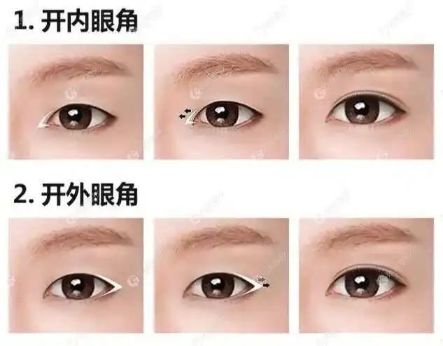 想问一下医生开内眼角和外眼角哪个显眼大