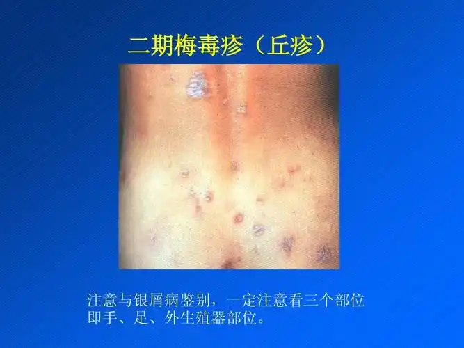二期梅毒疹(丘疹) 注意与银屑病鉴别,一定注意看三个部位 即手,足,外