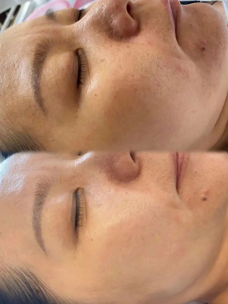 美业素材/高清对比图/脸部护理 166【光子嫩肤】案例对比护肤很重要