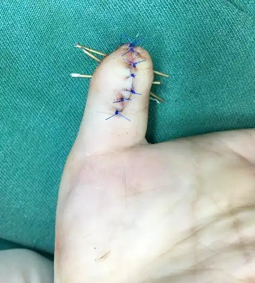 拇指多指畸形之一镜像拇—b-c手术_多指畸形_多指畸形治疗方式 - 好