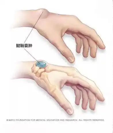 肌腱鞘横截面 1.腱纤维鞘2.腱系膜3.腱滑膜鞘壁层4.滑液腔5.