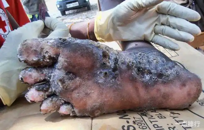 全球十大最恐怖的寄生虫 胆小勿入真的很渗人