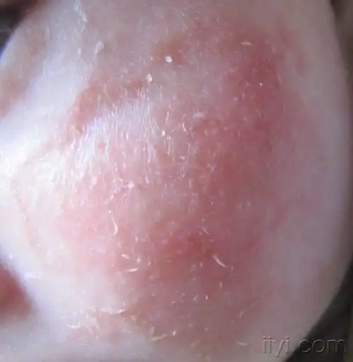 面部湿疹