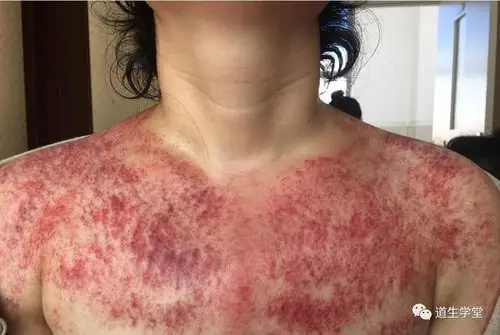 刮痧后患者反馈:肩膀背部轻松,无沉重束缚感.