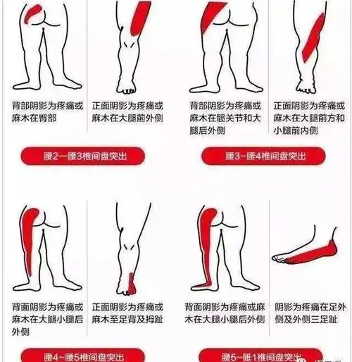 压痛及异常改变在臀中肌上,伴有坐骨神经痛症状出现,这时,通过梨状肌