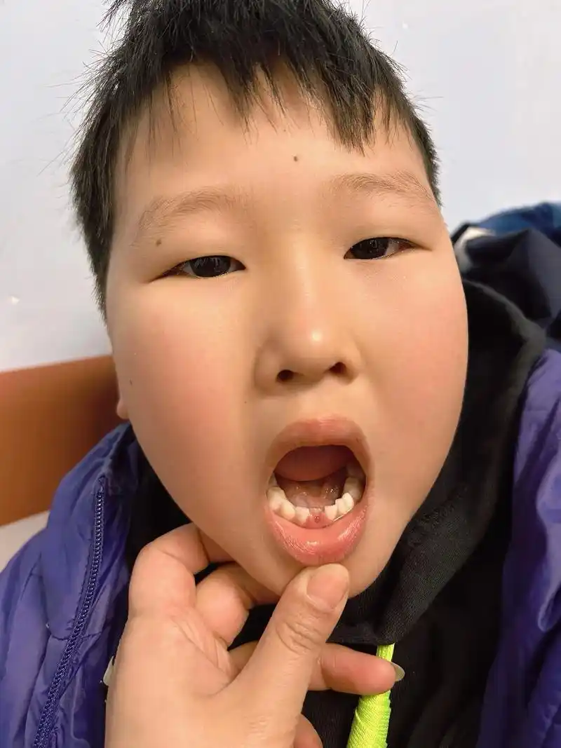 晚上才开始松动的,结果早上起床儿子问我"妈妈,我的牙齿是不是掉了,我
