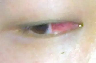 本人29岁,在22岁左右做过斜视手术.