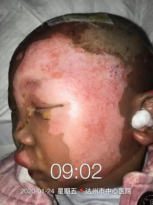 一例小儿头面部深二度烧伤,案例分享