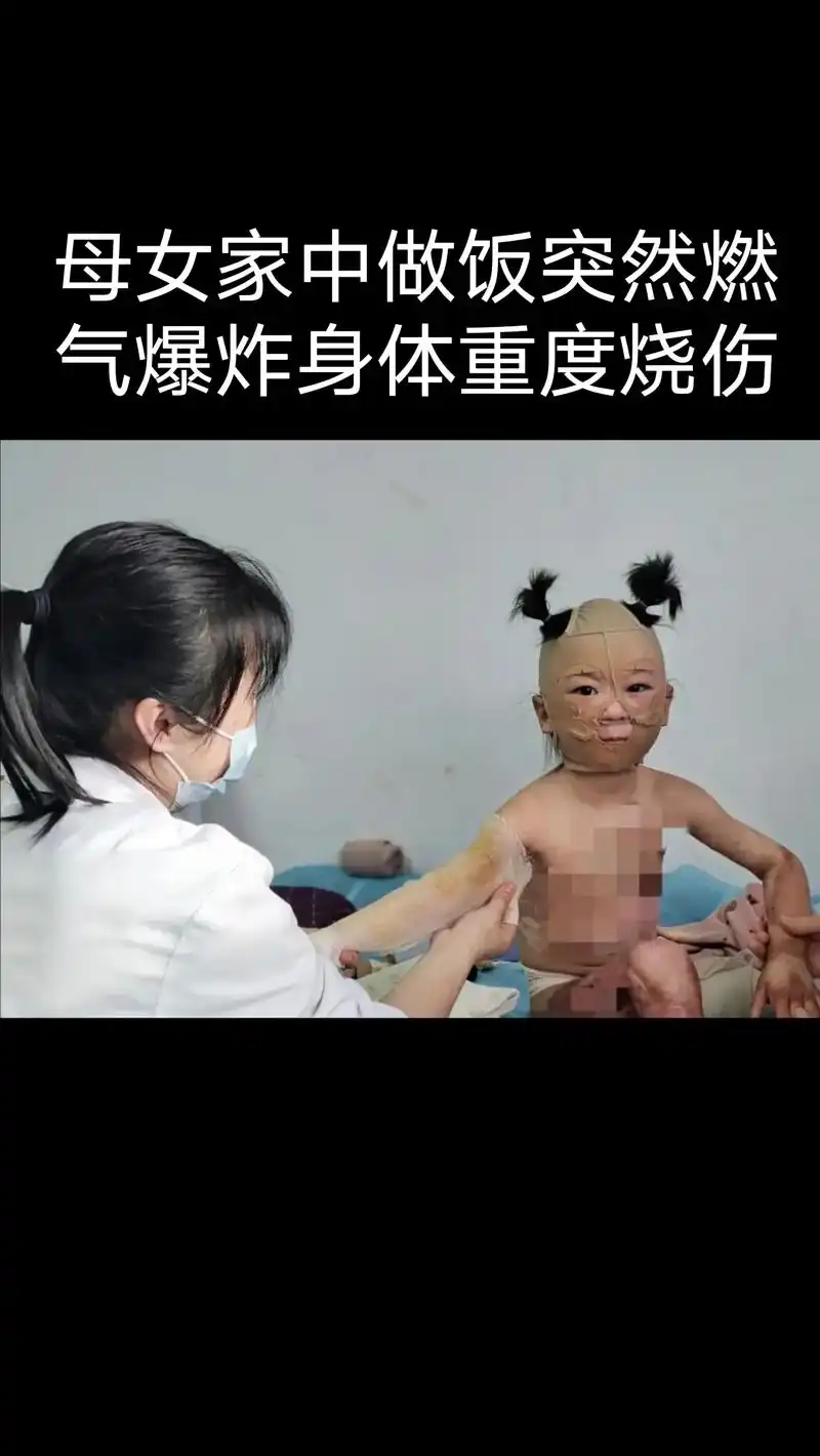 家中燃气爆炸母女重度烧伤,在icu几天花光所有积蓄,妈妈果断 - 抖音