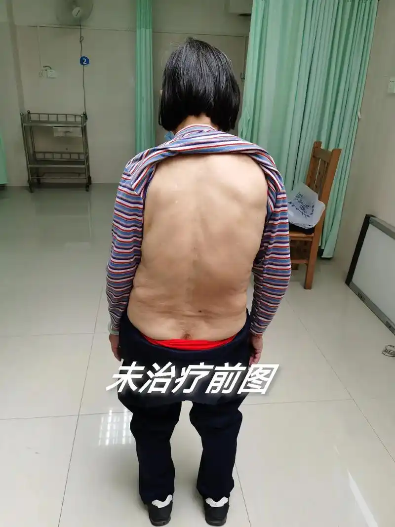 脊柱侧弯,腰椎间盘突出,不用手术也可以恢复,想了解点关注.# - 抖音